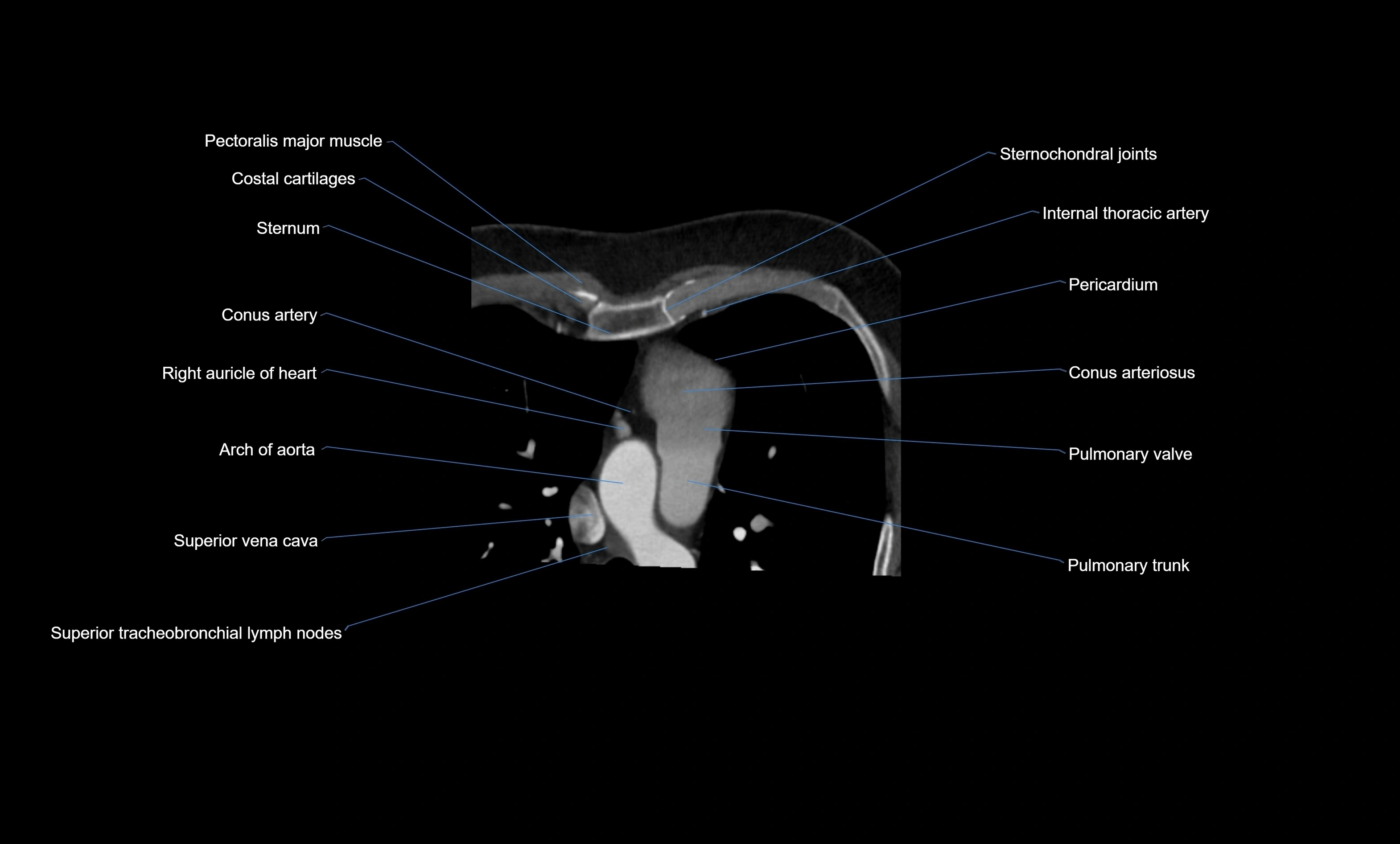 CT heart (coronary angiogram) four chamber view  cross sectional anatomy labelled radiology image -00012.webp
